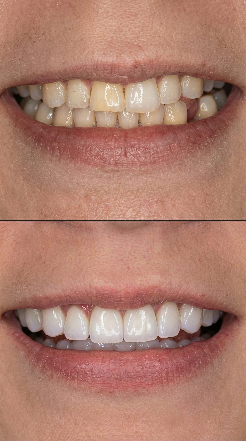 Caso real: antes y después de diseño de sonrisa en Müller Clinic