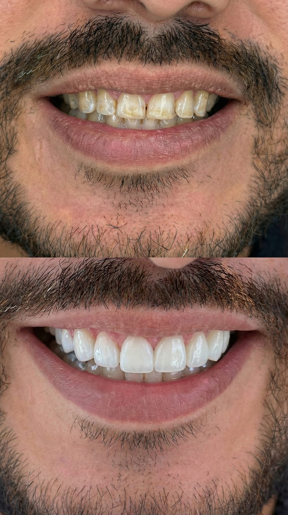Caso real: antes y después de carillas dentales en Müller Clinic